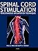 Algopix Similar Product 15 - Spinal Cord Stimulation Percutaneous