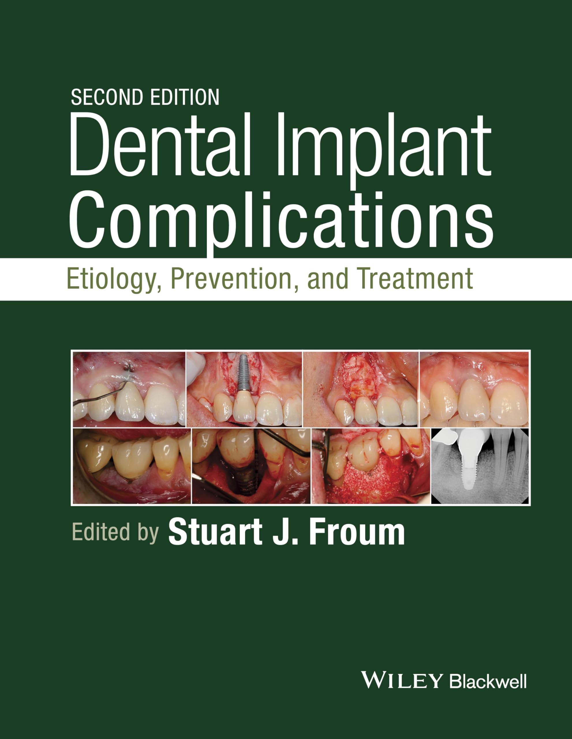 Algopix Similar Product 4 - Dental Implant Complications Etiology