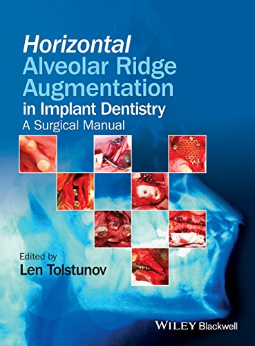Algopix Similar Product 5 - Horizontal Alveolar Ridge Augmentation