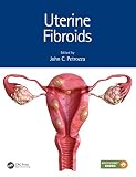 Algopix Similar Product 20 - Uterine Fibroids Reproductive Medicine