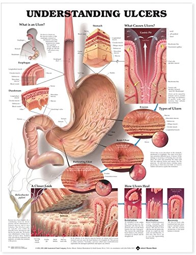 Algopix Similar Product 3 - Understanding Ulcers Anatomical Chart