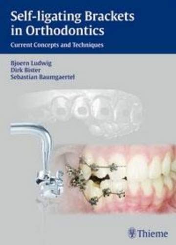 Algopix Similar Product 17 - Selfligating Brackets in Orthodontics