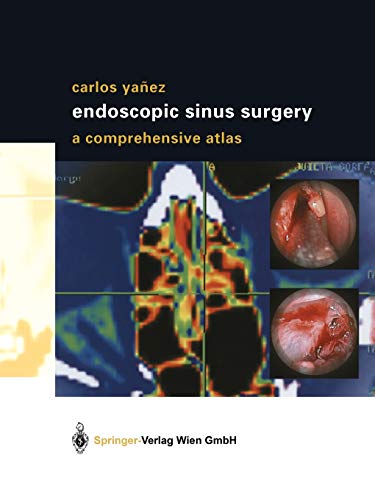 Algopix Similar Product 13 - Endoscopic Sinus Surgery A