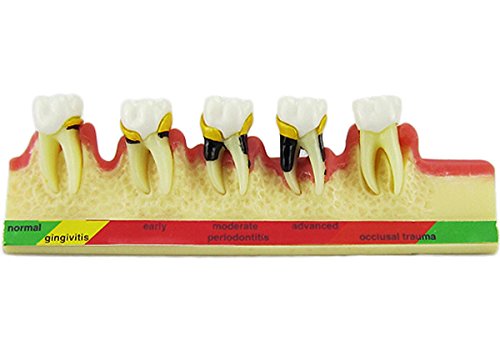 Algopix Similar Product 18 - Dental Periodontal Disease assort Tooth