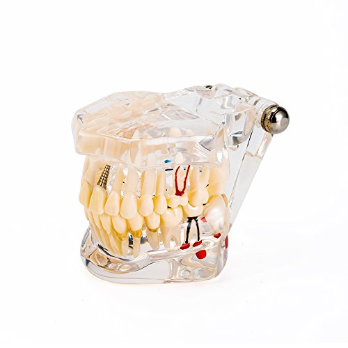 Algopix Similar Product 16 - Easyinsmile Dental Implant Disease