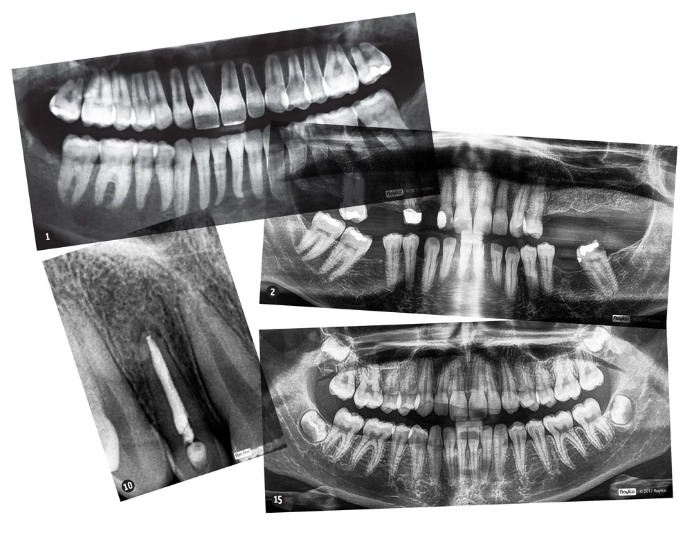 Algopix Similar Product 17 - Dental X-Rays