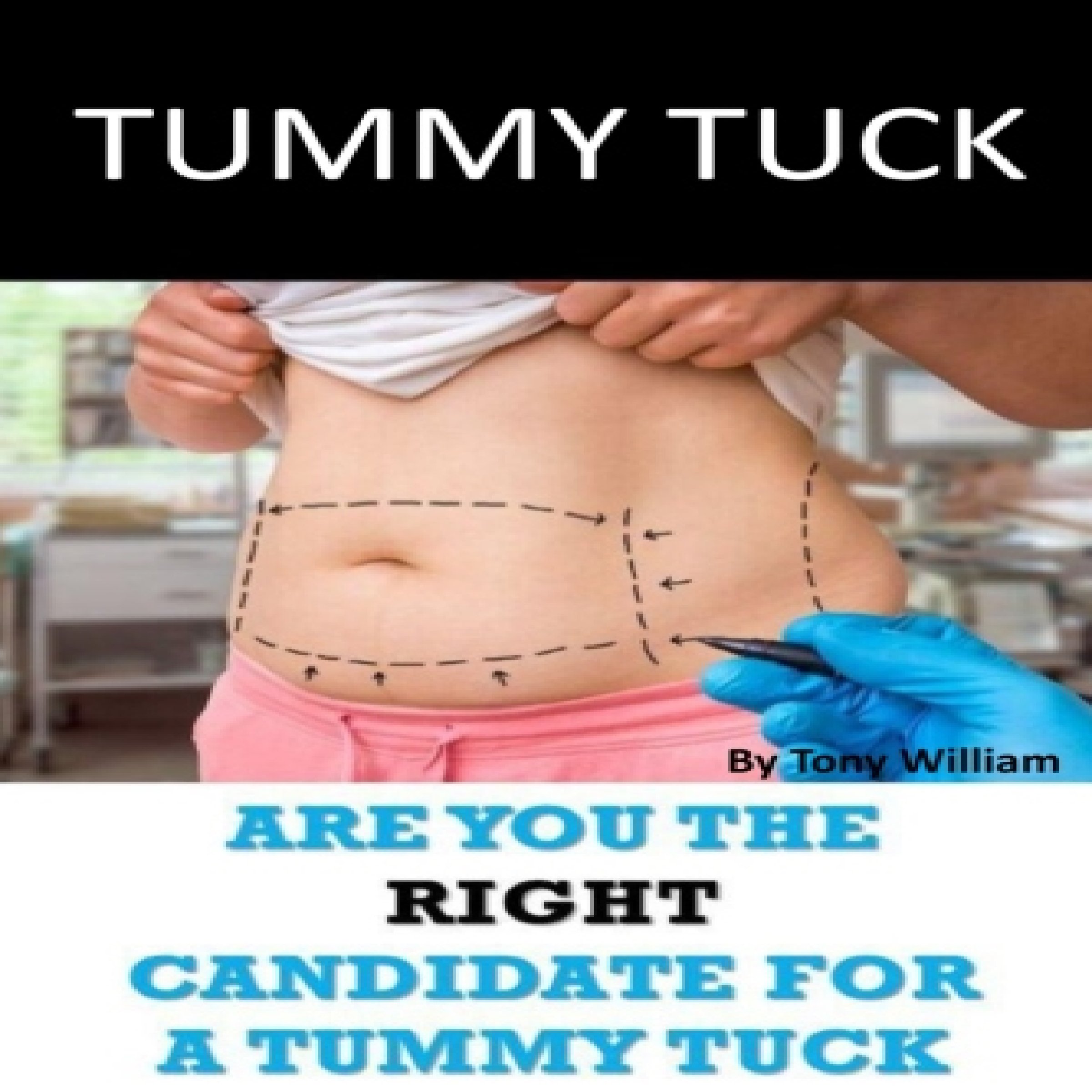 Algopix Similar Product 9 - Tummy Tuck Are You the Right Candidate