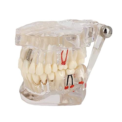 Algopix Similar Product 5 - Transparent Disease Teeth Model YOUYA