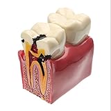 Algopix Similar Product 20 - Dental Caries Tooth Model YOUYA DENTAL