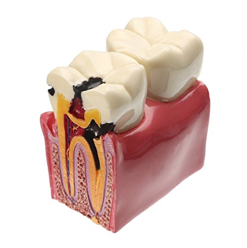 Algopix Similar Product 18 - Dental Caries Tooth Model YOUYA DENTAL