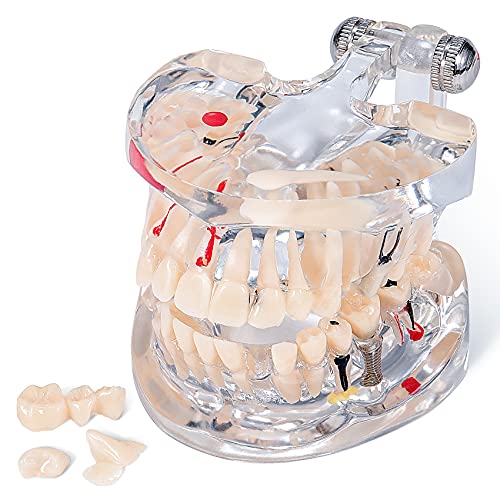 Algopix Similar Product 2 - Annhua Transparent Tooth Model Dental