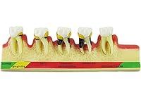 Algopix Similar Product 12 - Dental Periodontal Disease assort Tooth